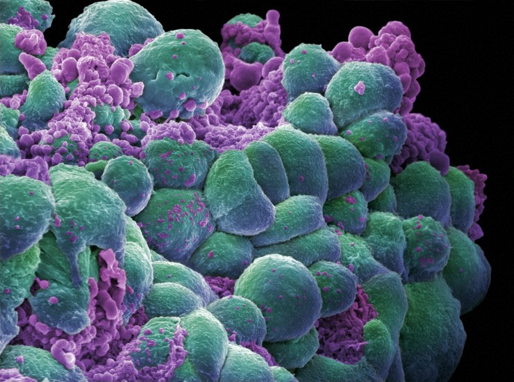 תאי סרטן השד תחת המיקרוסקופ (אילוסטרציה)