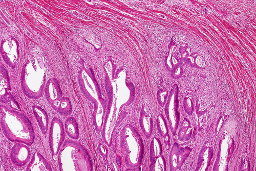תמונה מיקרוסקופית של סרטן המעי הגס (אילוסטרציה)