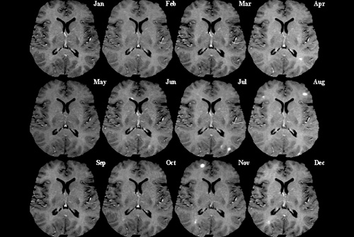 MRI המראה פגיעה של טרשת נפוצה במיאלין -הנקודות הבהירות (מקור: ויקיפדיה)