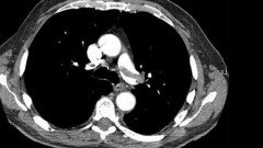 צילום עורקי הריאה בעזרת טומוגרפיה ממוחשבת (CTPA). מקור: ויקיפדיה
