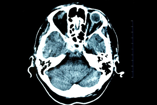 בדיקת טומוגרפיה ממוחשבת (CT) לאיבחון מפרצת במוח (אילוסטרציה)