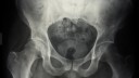 צילום רנטגן של מפרקי הירך (צילום: אילוסטרציה)