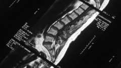 MRI של עמוד השדרה (צילום: אילוסטרציה)