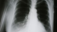 צילום רנטגן של חולה COPD (צילום: אילוסטרציה)