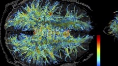 תמונת MRI של החומר הלבן במוח (מקור: ויקיפדיה)
